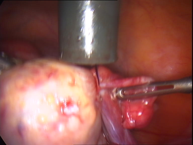 tightining the loop around ovarian pedicle tightining the loop around ovarian pedicle
